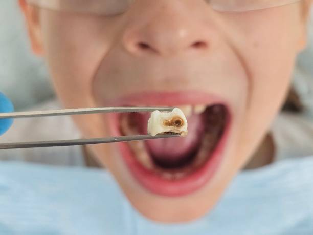 Best Broken or Cracked Tooth Emergency Dentist in Pickens, SC